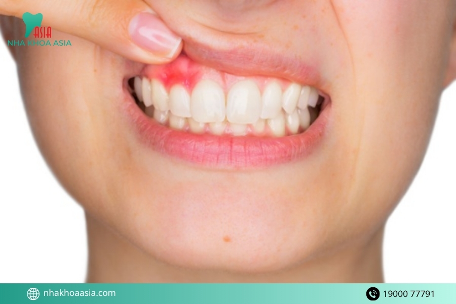 Bọc răng sứ bị đau chân răng nguyên nhân do đâu?