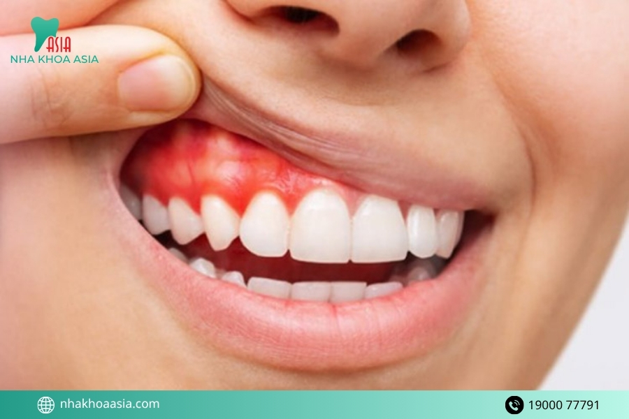Bọc răng sứ bị đau chân răng có bình thường không?