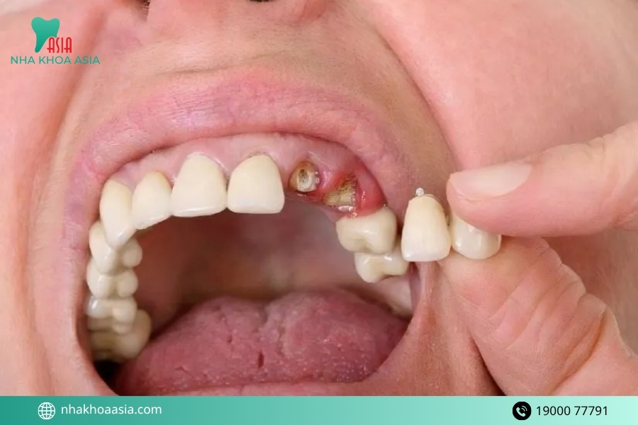 Bọc răng sứ bị đau chân răng nguyên nhân do đâu?