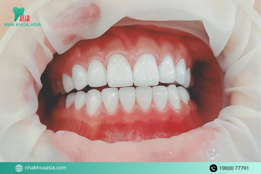Bọc răng sứ bị đau chân răng nguyên nhân do đâu?
