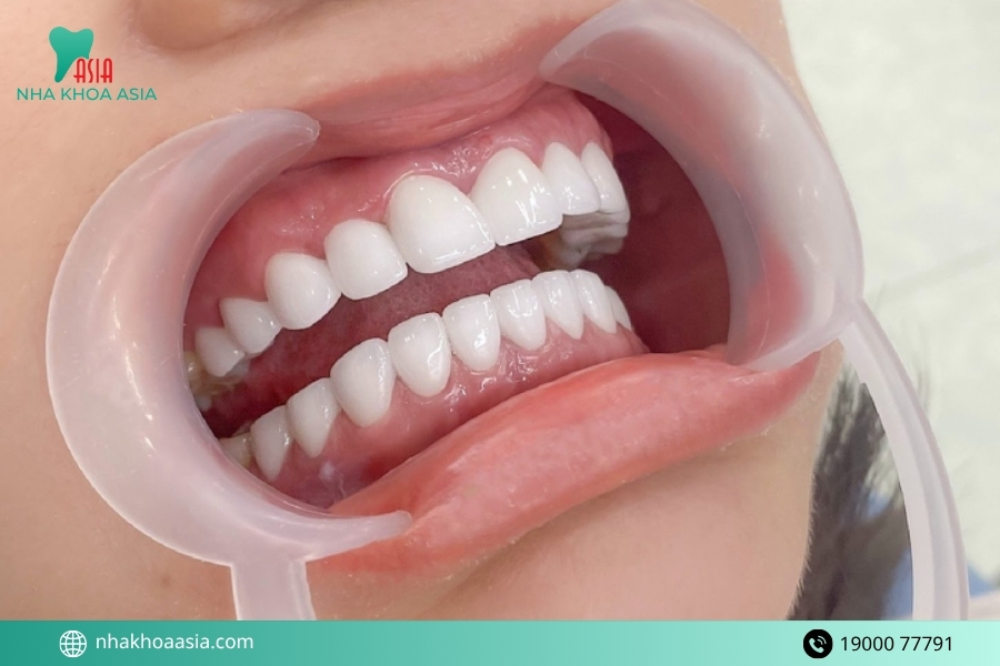 Dấu hiệu nhận biết bọc răng sứ bị đau chân răng nguy hiểm