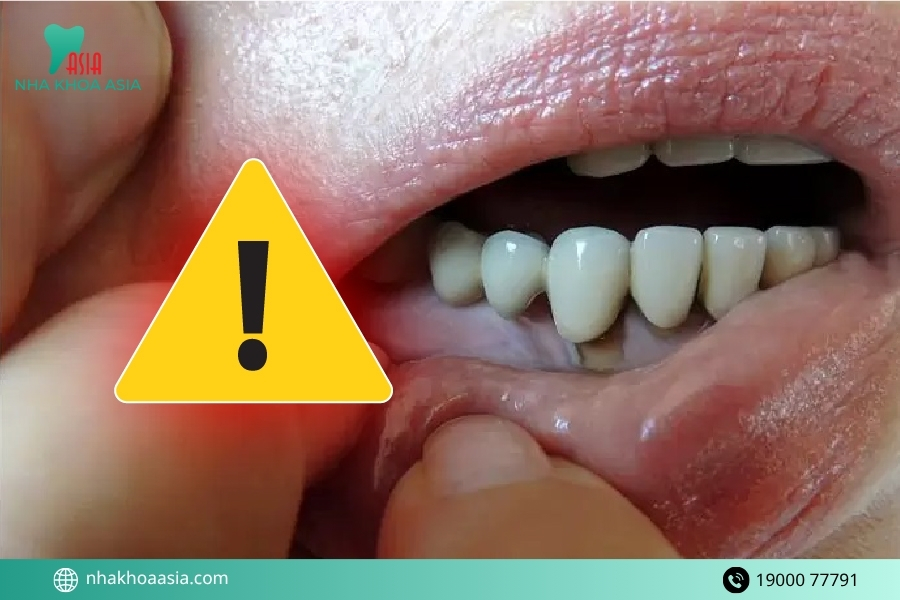 Một số nguyên nhân dẫn đến bọc răng sứ bị hở chân răng