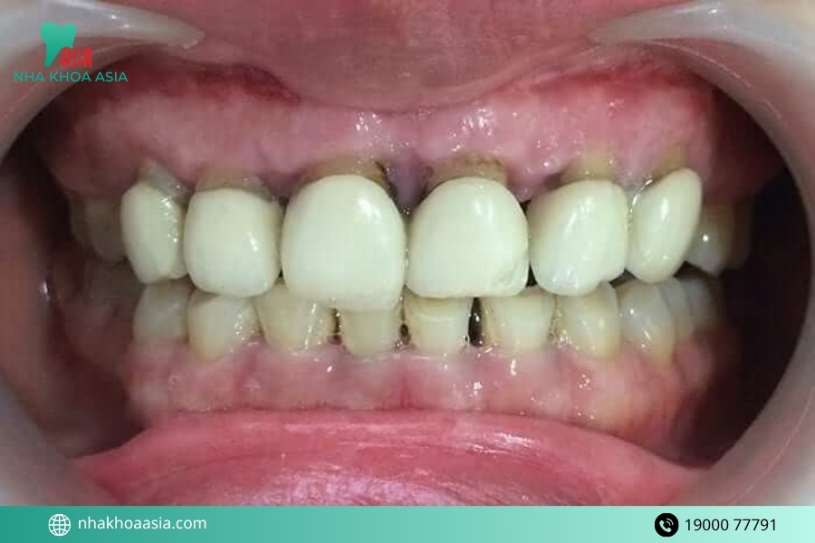 Bọc răng sứ bị hở lợi không điều trị có ảnh hưởng như thế nào?