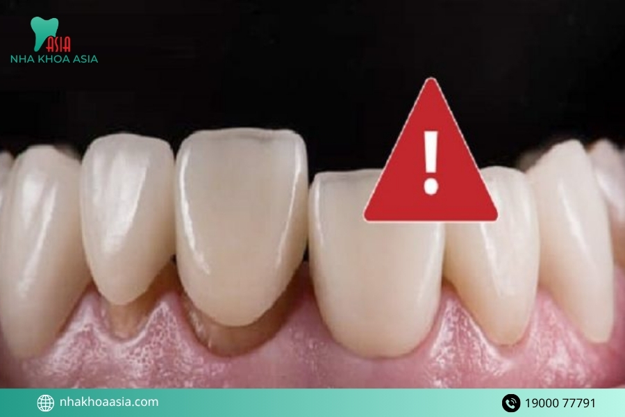 Làm sao để tránh tình trạng răng sứ bị hở?
