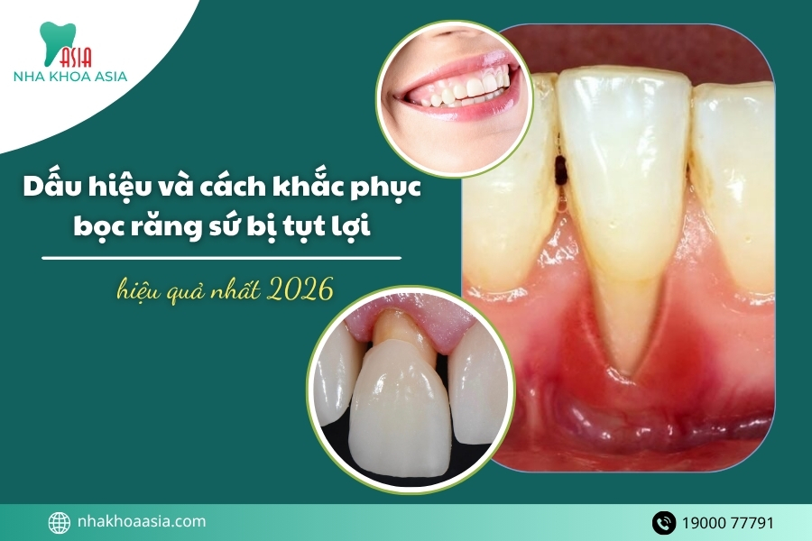 Dấu hiệu và cách khắc phục bọc răng sứ bị tụt lợi hiệu quả nhất 2026