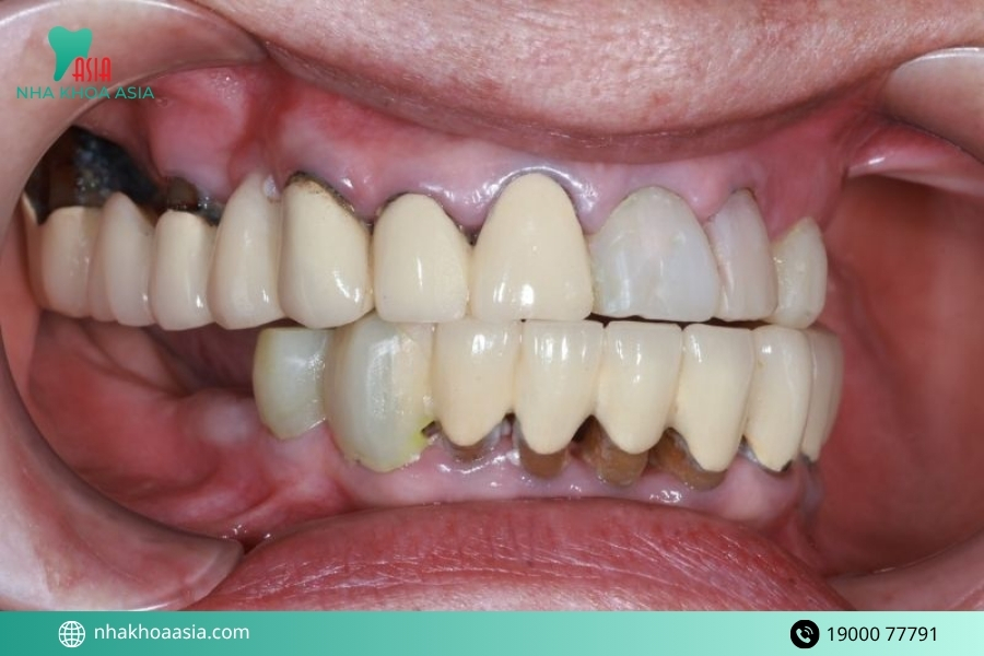 Bọc răng sứ bị tụt lợi có nguy hiểm không? Ảnh hưởng không?