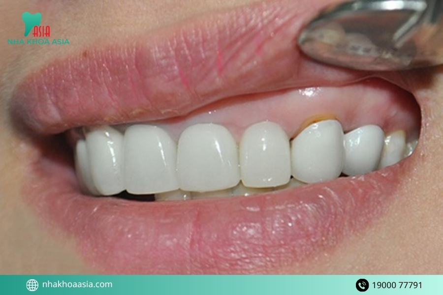 Cách khắc phục bọc răng sứ bị tụt lợi theo từng trường hợp