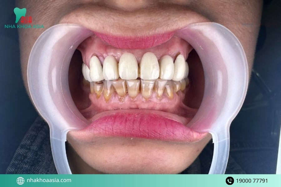 Cách phòng tránh tụt lợi sau khi bọc răng sứ