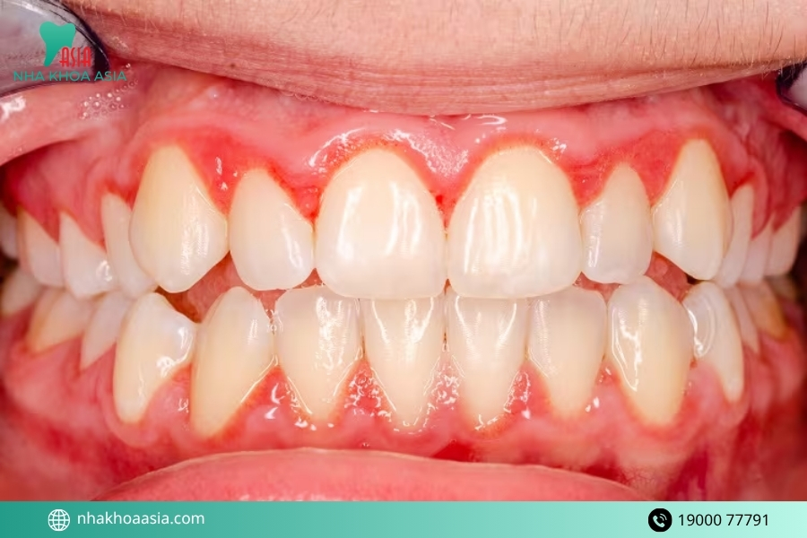 Làm sao để tránh bị viêm nướu khi bọc răng sứ?