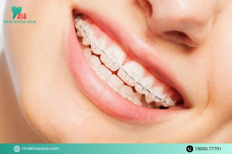 Những rủi ro có thể gặp nếu niềng răng sau khi bọc răng sứ sai cách