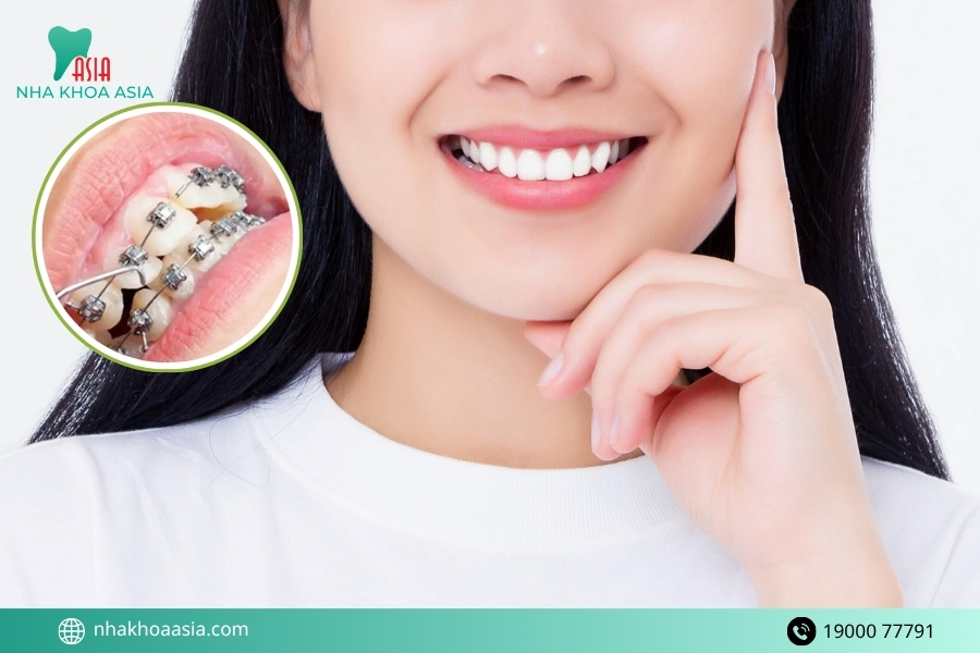 Bọc răng sứ sau bao lâu thì có thể niềng răng được?