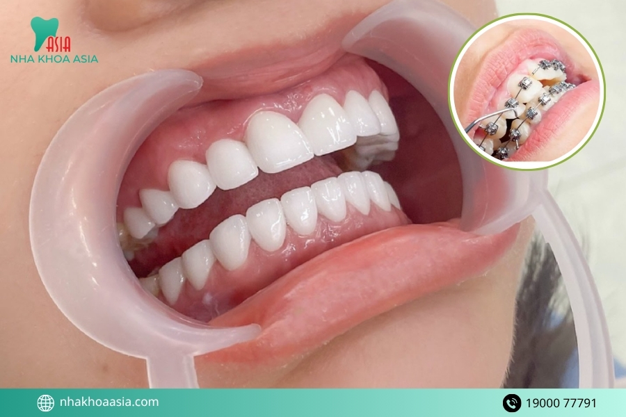  Có nên bọc răng sứ và niềng răng cùng một thời điểm không? 