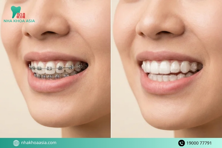 Thời gian niềng răng cho người bọc sứ kéo dài bao lâu?