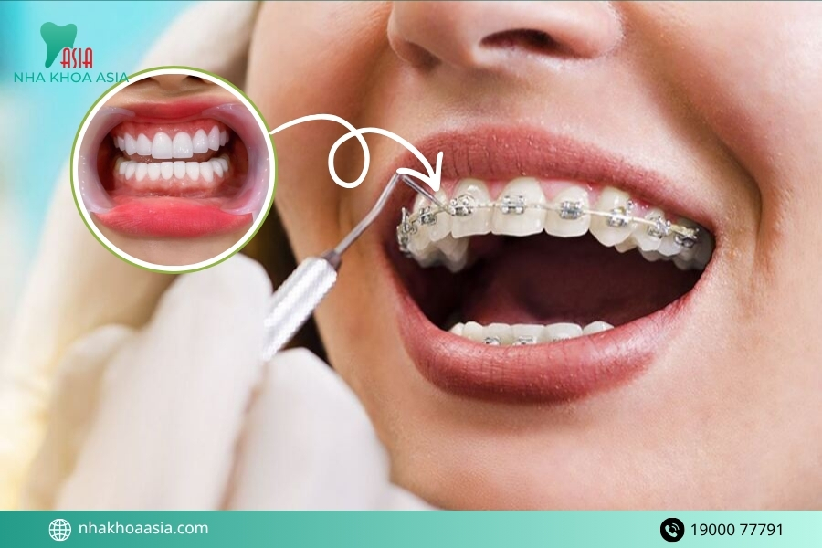 Vì sao niềng răng trên răng đã bọc sứ khó hơn bình thường?