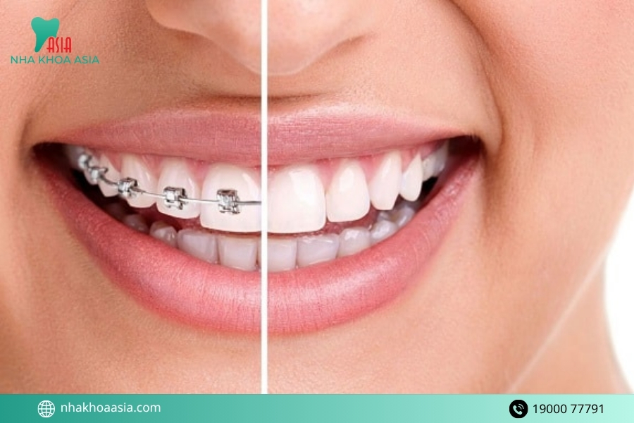Giải pháp tối ưu khi đã bọc răng sứ nhưng muốn niềng răng