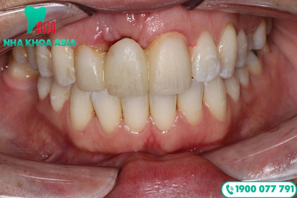 Kỹ thuật nha khoa kém chất lượng có thể khiến răng sứ bị hư hỏng nhanh chóng