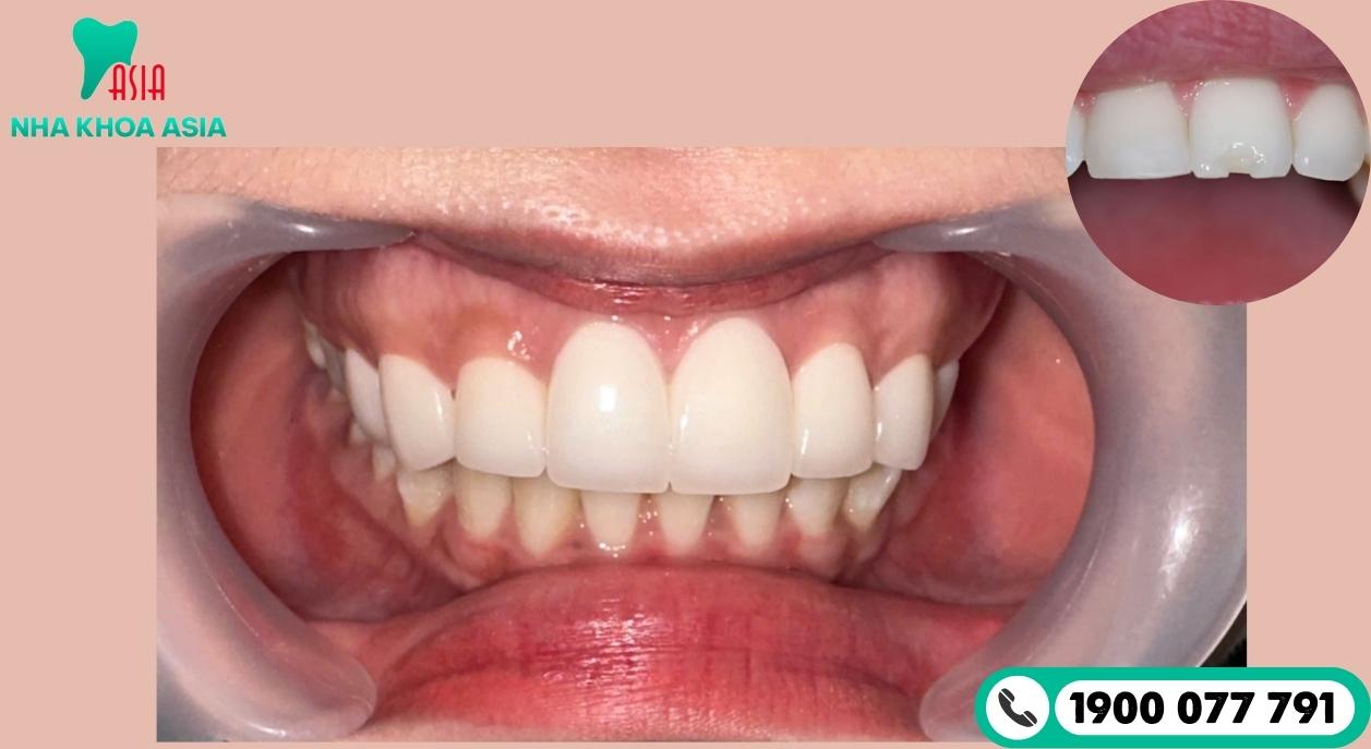 Bọc răng sứ có thể thay thế khi hư hỏng, phục hồi lại vẻ đẹp và sức nhai