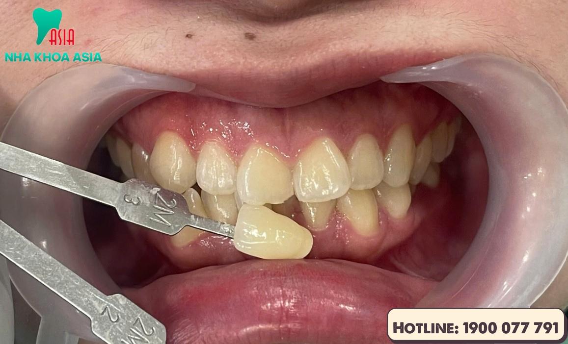 Những trường hợp cần thay răng sứ như: răng bị vỡ, bong tróc hoặc ố vàng