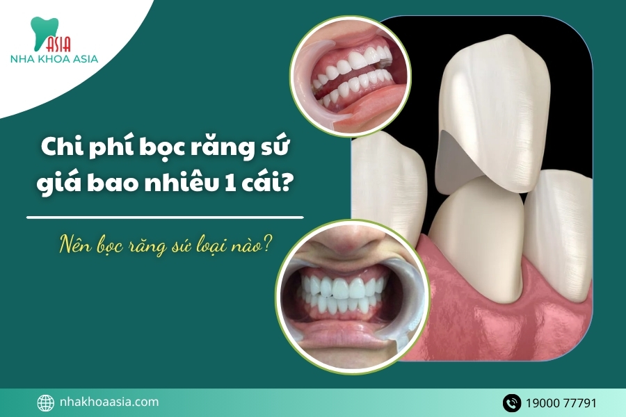 Chi phí bọc răng sứ giá bao nhiêu 1 cái? Nên bọc răng sứ loại nào?