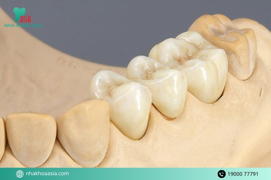 Những loại răng bọc sứ phổ biến và chất lượng nhất 2026
