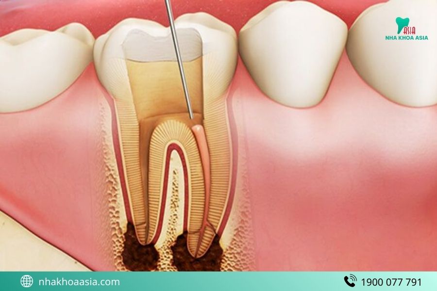 Lấy tủy răng là gì?
