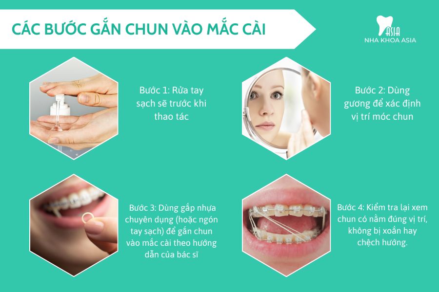 Các bước gắn chun vào mắc cài