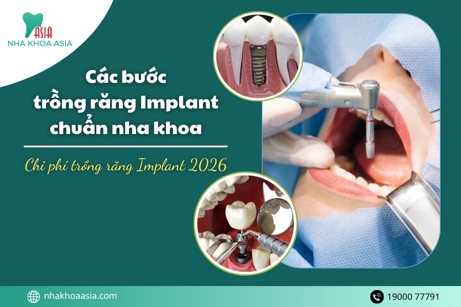 Các bước trồng răng Implant chuẩn nha khoa? Cập nhật chi phí 2026