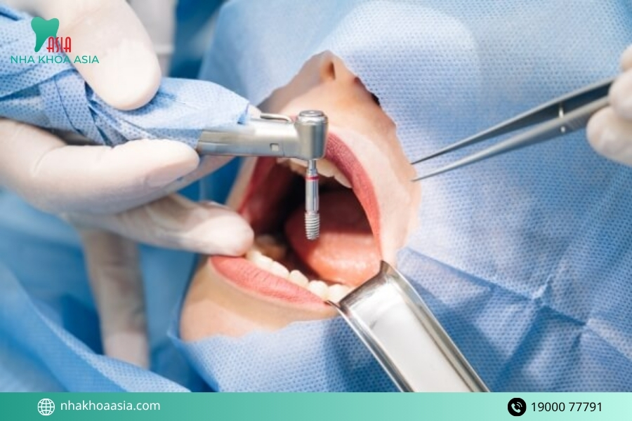 Yếu tố đánh giá bạn có phù hợp để trồng răng implant hay không