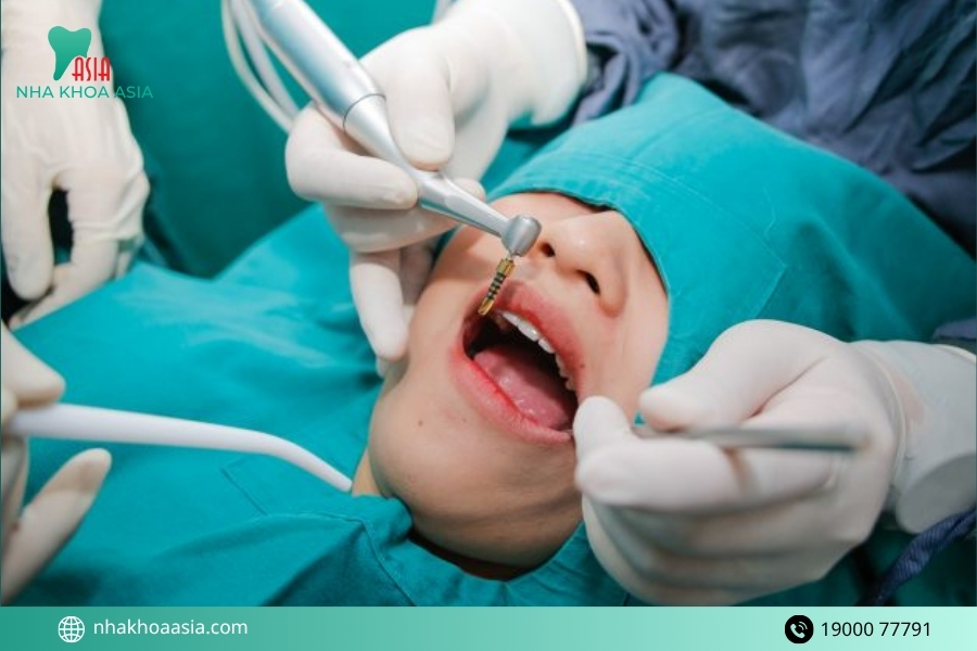 Các bước trồng răng Implant chuẩn nha khoa