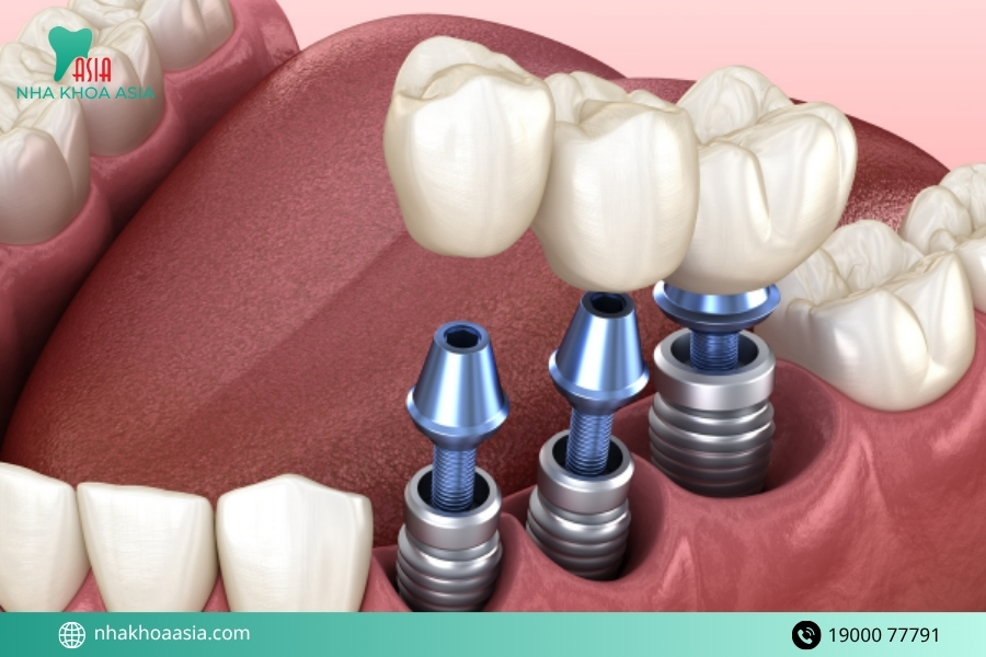 Các bước trồng răng Implant chuẩn nha khoa