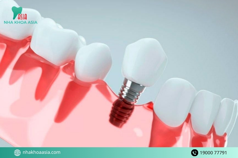 Các bước trồng răng Implant chuẩn nha khoa