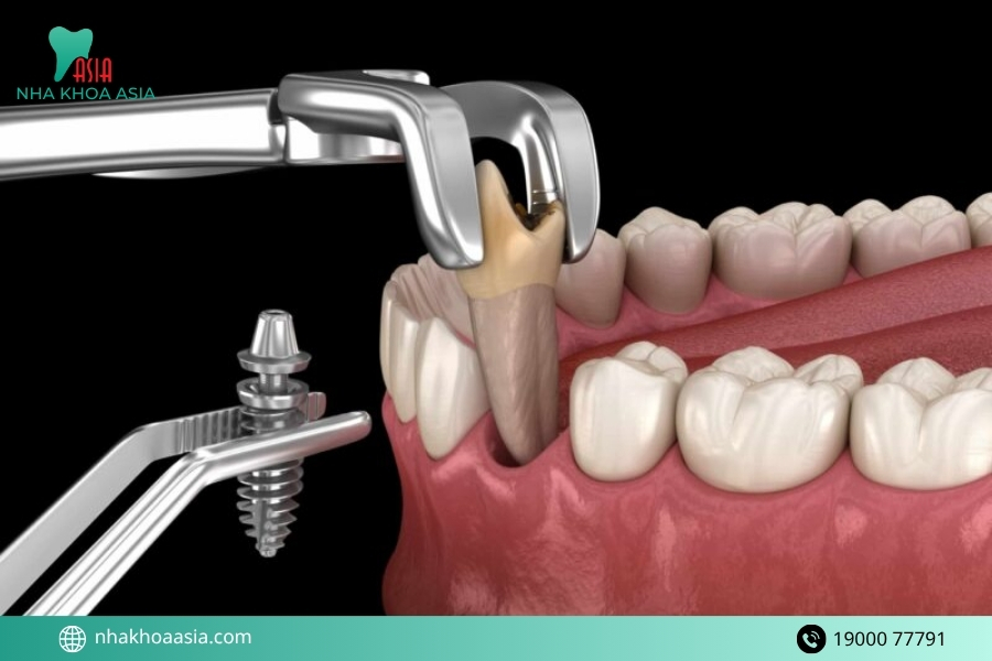 Trồng răng implant mất bao lâu để hoàn thành?