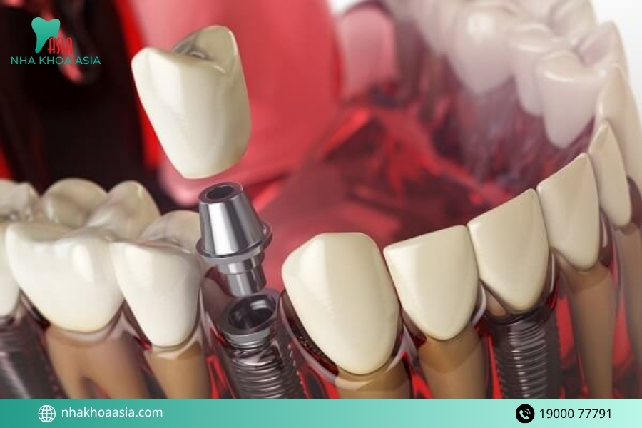 Những loại trụ trồng răng implant phổ biến nhất hiện nay