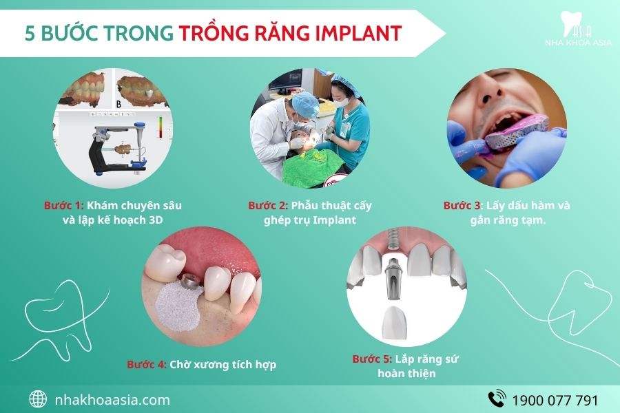 Các bước trồng răng Implant