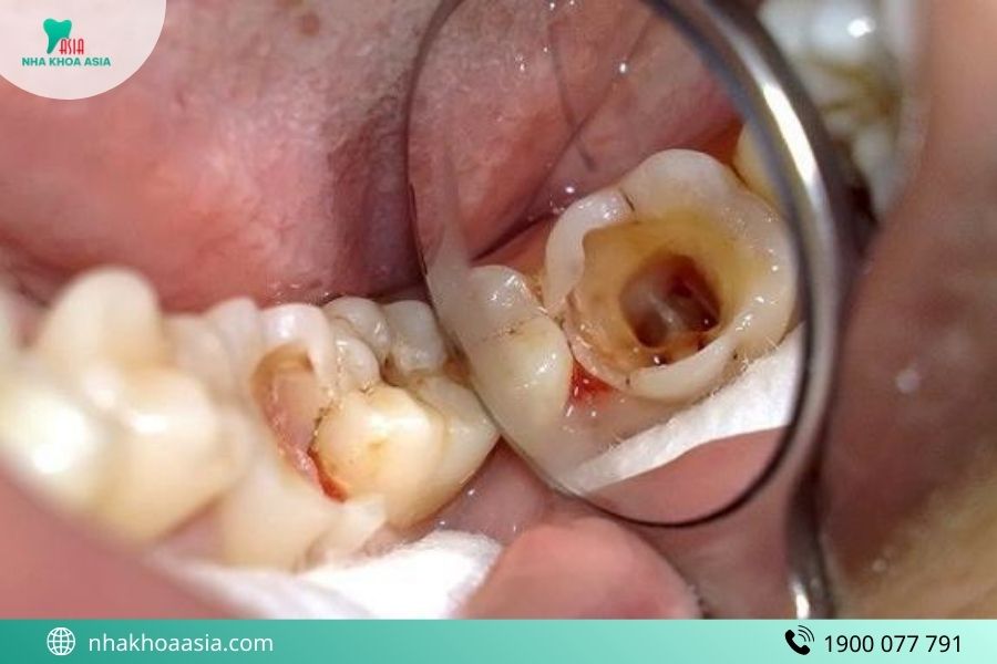 Các phương pháp điều trị sâu răng đau nhức