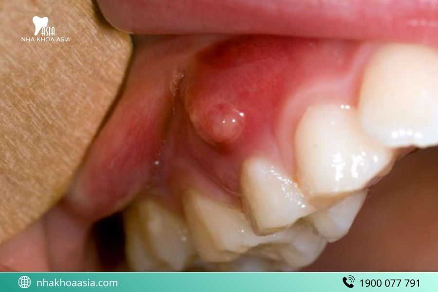 Cách chữa viêm tủy răng tại nhà