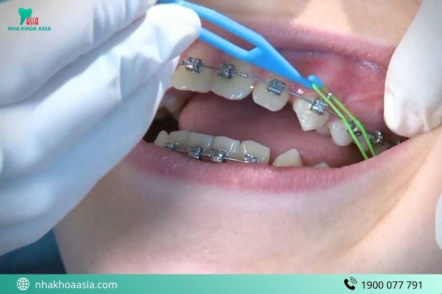 Cách gắn và bảo quản chun niềng răng