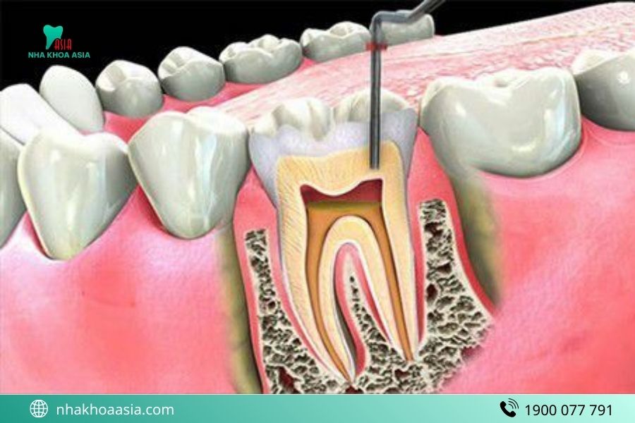 Cách giảm đau sau khi lấy tủy răng