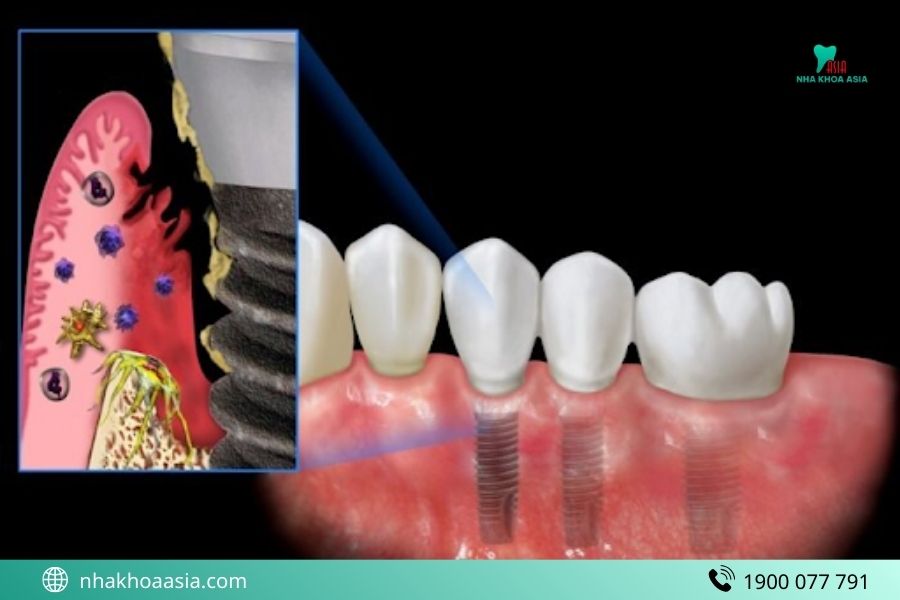 Cách phòng tránh hối hận khi trồng Implant