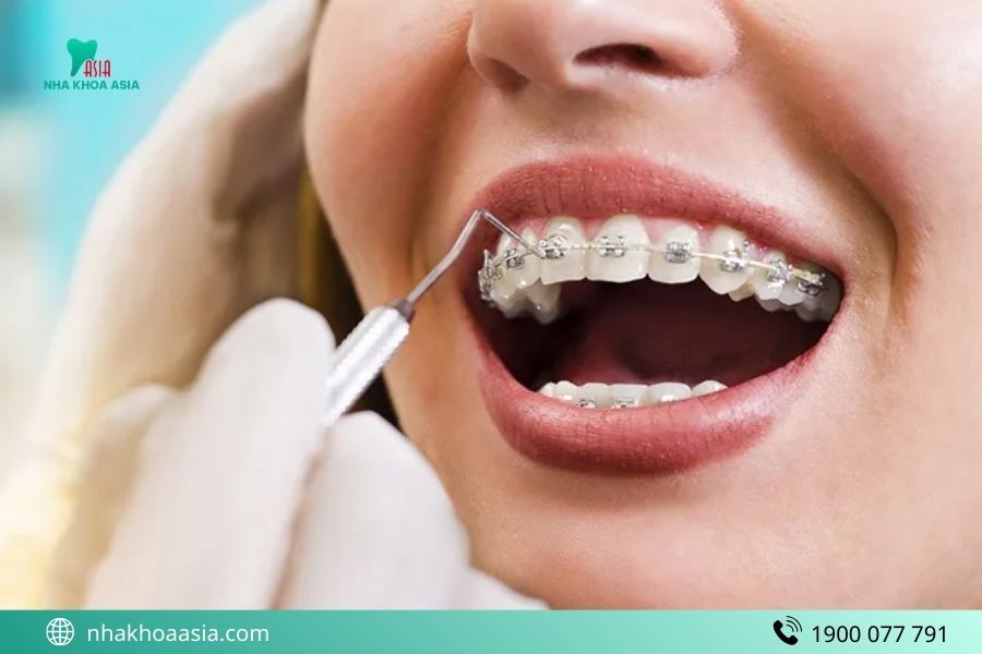 Cách vệ sinh răng miệng sau khi cắm minivis