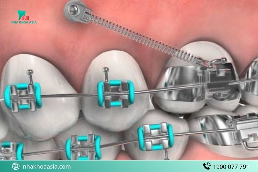 Những lưu ý sau khi cắm minivis