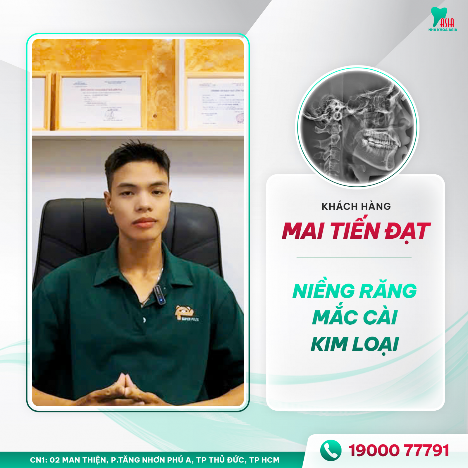 Khách hàng Mai Tiến Đạt niềng răng mắc cài kim loại