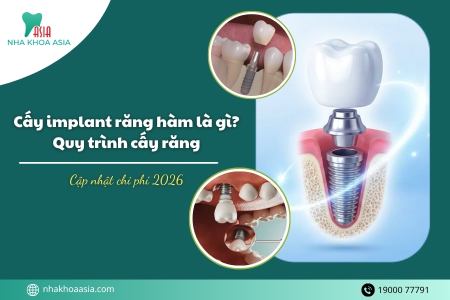 Cấy implant răng hàm là gì? Ưu nhược điểm, quy trình, chi phí 2026