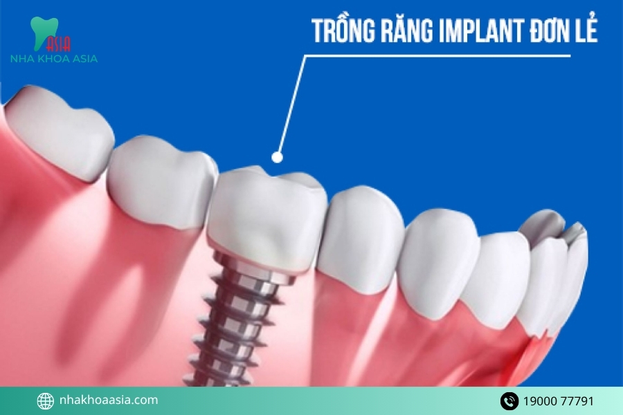 Những rủi ro khi cấy implant răng hàm nếu làm sai kỹ thuật