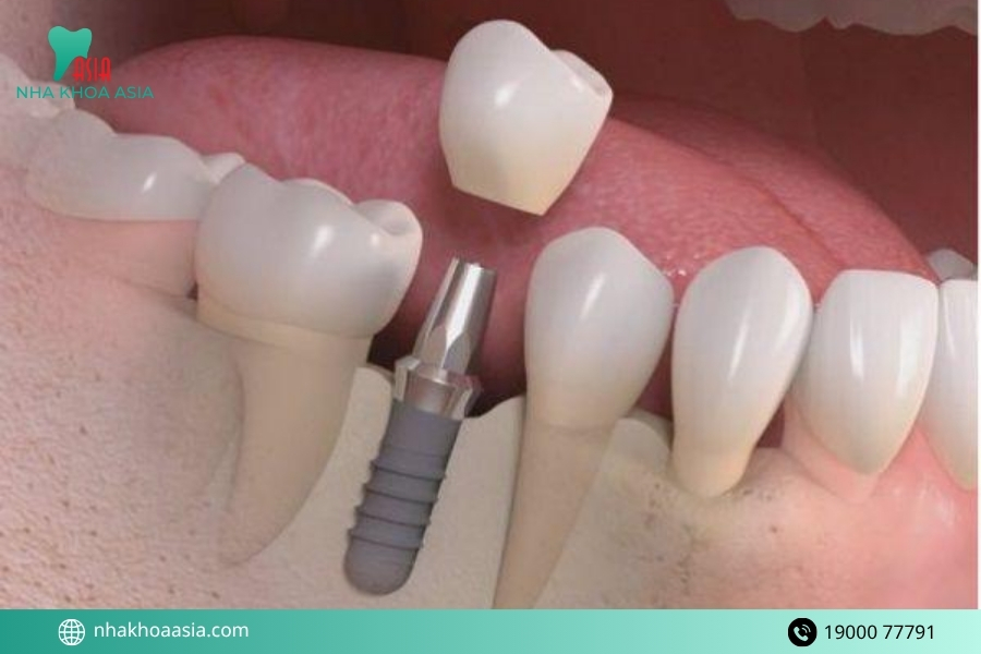 Cấy implant răng hàm phù hợp với những đối tượng nào?