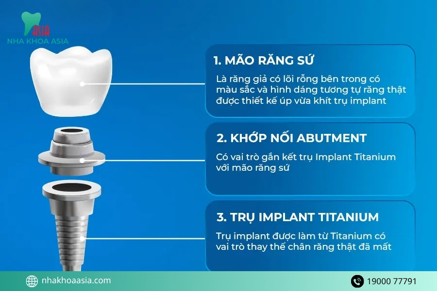 Cấy implant răng hàm là gì? Cấu tạo 1 răng implant hoàn chỉnh