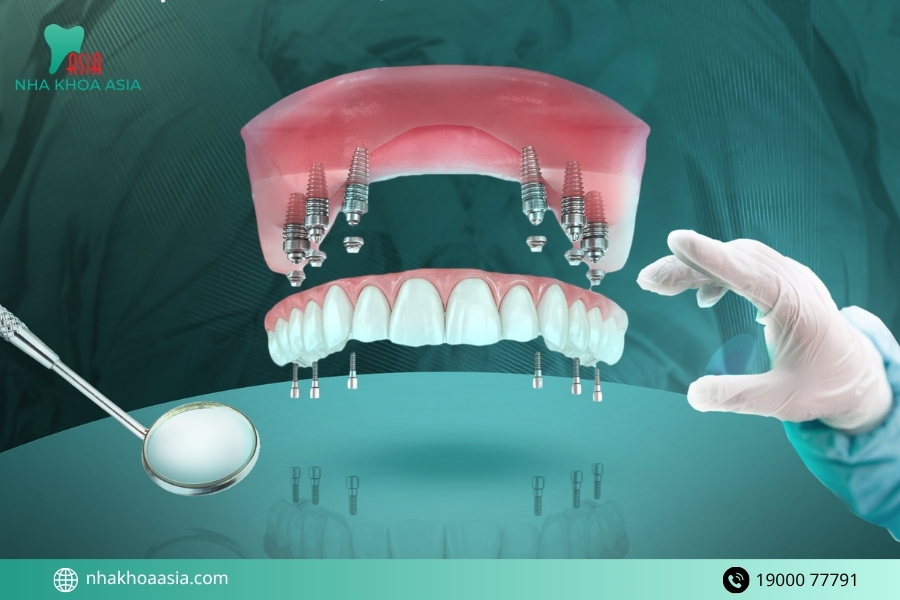 Ưu và nhược điểm của việc cấy implant răng hàm