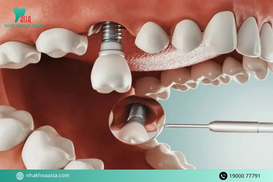 Ưu và nhược điểm của việc cấy implant răng hàm