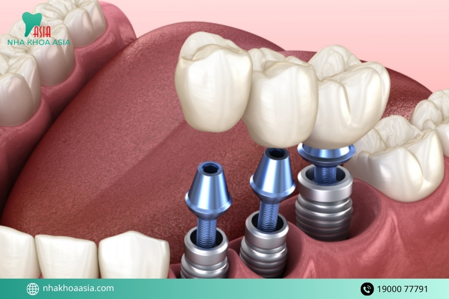 Quy trình cấy implant răng hàm chuẩn y khoa