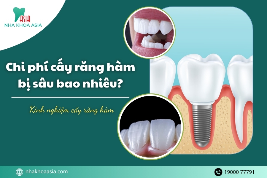 Chi phí cấy răng hàm bị sâu bao nhiêu? Kinh nghiệm cấy răng hàm hiệu quả